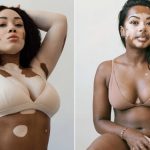 Photographer with Vitiligo Captures Images of Women Sharing the Same Condition (30 Photos)
